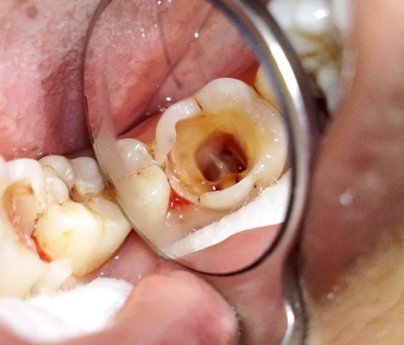 Răng sâu lớn, chữa tủy bọc sứ là chỉ định bắt buộc